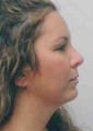 Chin Liposuction