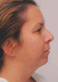 Chin Liposuction