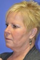 Woman, skin rejuvenation cheeks and neck