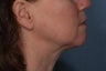 Female treated for Sagging Skin at Jawline