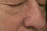 nose vessels treated with pulsed dye laser (PDL)