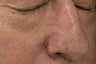 nose vessels treated with pulsed dye laser (PDL)