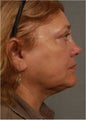 62 year old female with a turkey neck would prefer Smart Lipo over a traditional neck lift