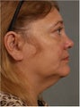 62 year old female with a turkey neck would prefer Smart Lipo over a traditional neck lift