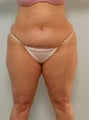 Body Lift