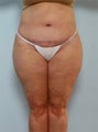 Body Lift