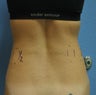 Liposonix