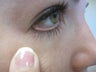 Mole Removal