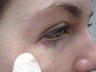 Mole Removal