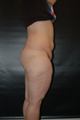 Lipoabdominoplasty, Brazilian Butt lift, Medial Thighlift