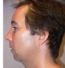 41 year old man gets Chin Implant Surgery