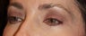 Female with Eyelid Surgery