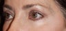 Female with Eyelid Surgery