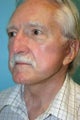 75 Year Old Male Interested in Facial Rejuvenation