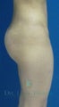 Buttock Augmentation or Brazlian Butt Lift