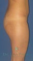 Buttock Augmentation or Brazlian Butt Lift