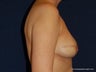 Breast Reconstruction