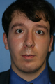 Otoplasty