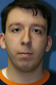 Otoplasty