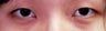 Bilateral Asian Eyelid Surgery