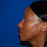 Chin Augmentation