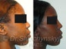 African American Rhinoplasty