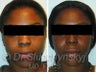 African American Rhinoplasty