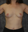 Breast Lift