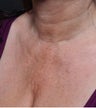 52 year old woman who underwent décolletage (cleavage) rejuvenation