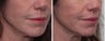 Liplift Before & After Photos Patient