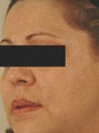 IPL Photofacial with Q-switched lasers.