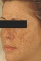 IPL Photofacial with Q-switched lasers.