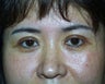 Asian patient with upper bleph