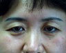 Asian patient with upper bleph
