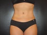 Hi-definition sculplting with Smartlipo and "PRO-Sculpt" Formula