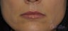 42 y/o female desired fuller lips with filler.