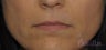 42 y/o female desired fuller lips with filler.