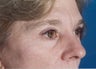 54 Year Old Female Underwent Lower and Upper Eyelid Surgery