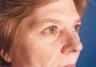 54 Year Old Female Underwent Lower and Upper Eyelid Surgery