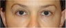 Restylane