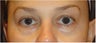 Restylane