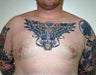 Adult Male treated for Breast Reduction