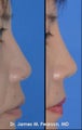 Rhinoplasty / Nasal Surgery