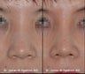 Rhinoplasty / Nasal Surgery