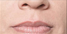 Juvederm