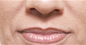 Juvederm