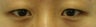 Bilateral Asian Eyelid Surgery