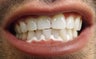 Young Male After ZOOM Teeth Whitening