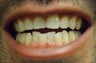 Young Male After ZOOM Teeth Whitening