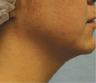 SmartLipo